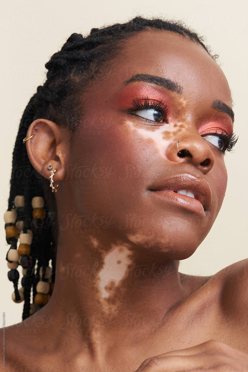 Beauty Portrait of Young Black Woman with Vitiligo Natural Lighting