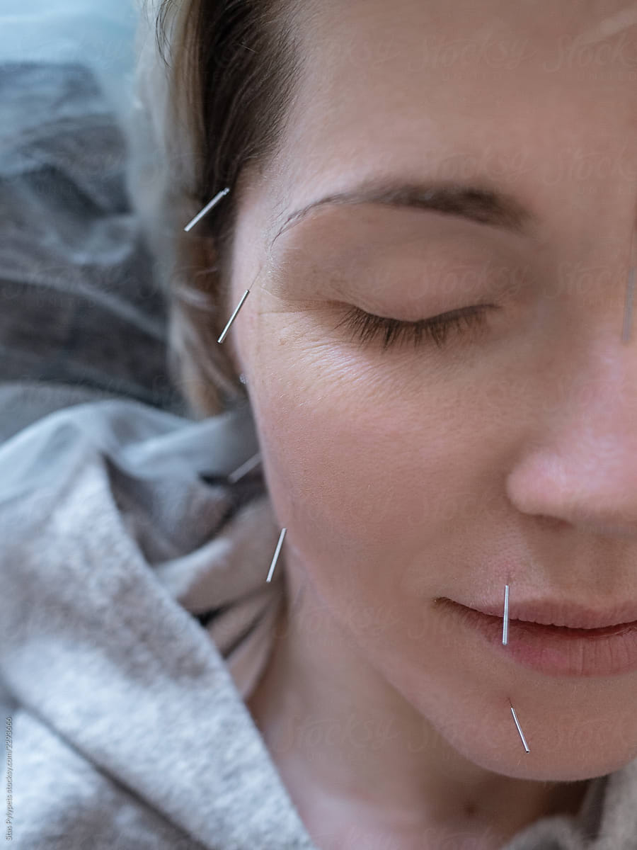 Portrait of a girl on the acupuncture procedure