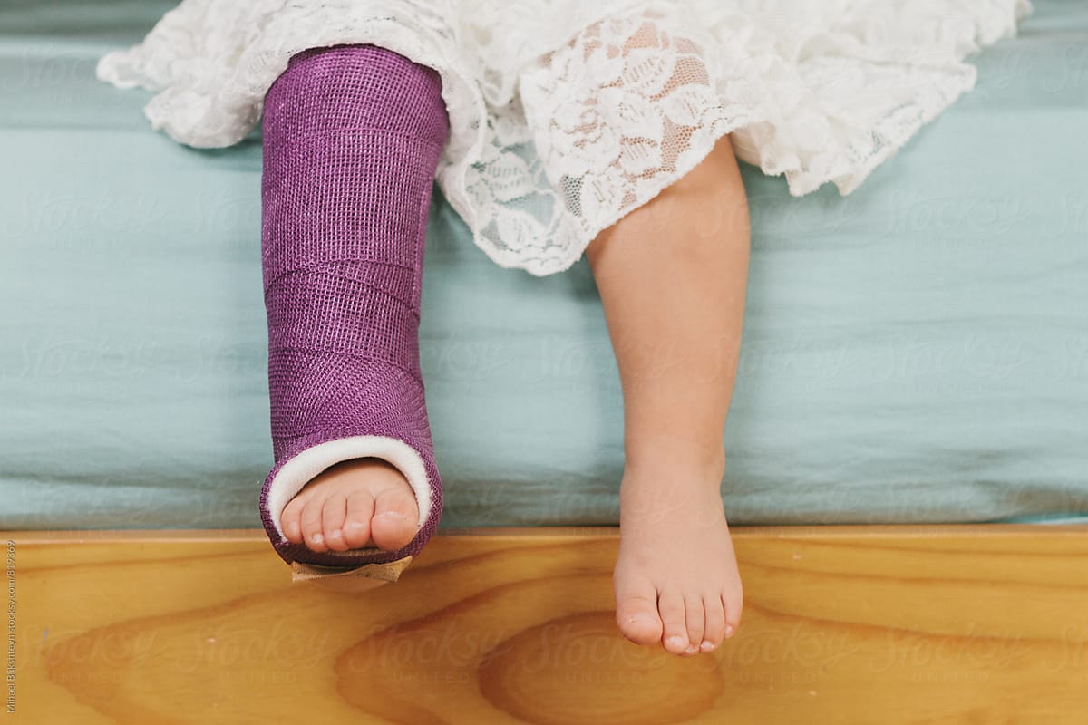 View of young girl\'s legs hanging from bed with one leg in a cast