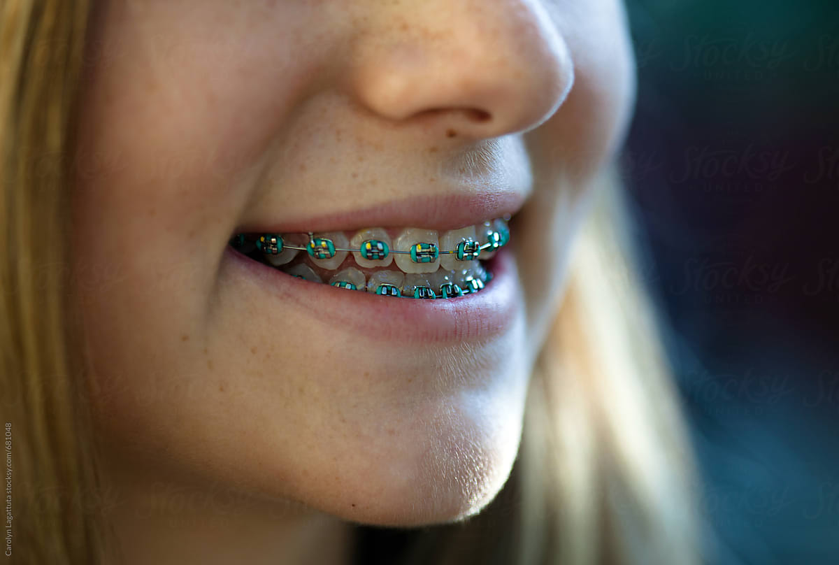 Close up of a smiling teenage girl smiling with colored braces