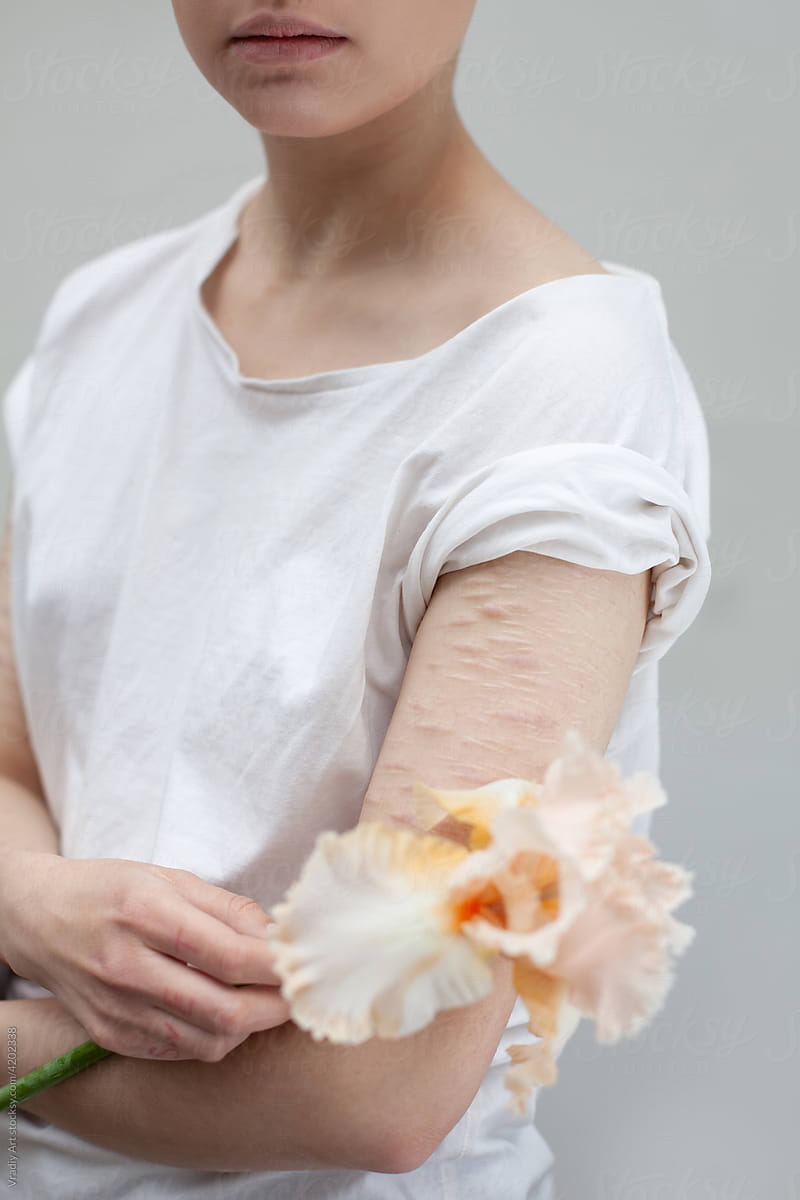 Sensual woman with pale scars arm holds a flower