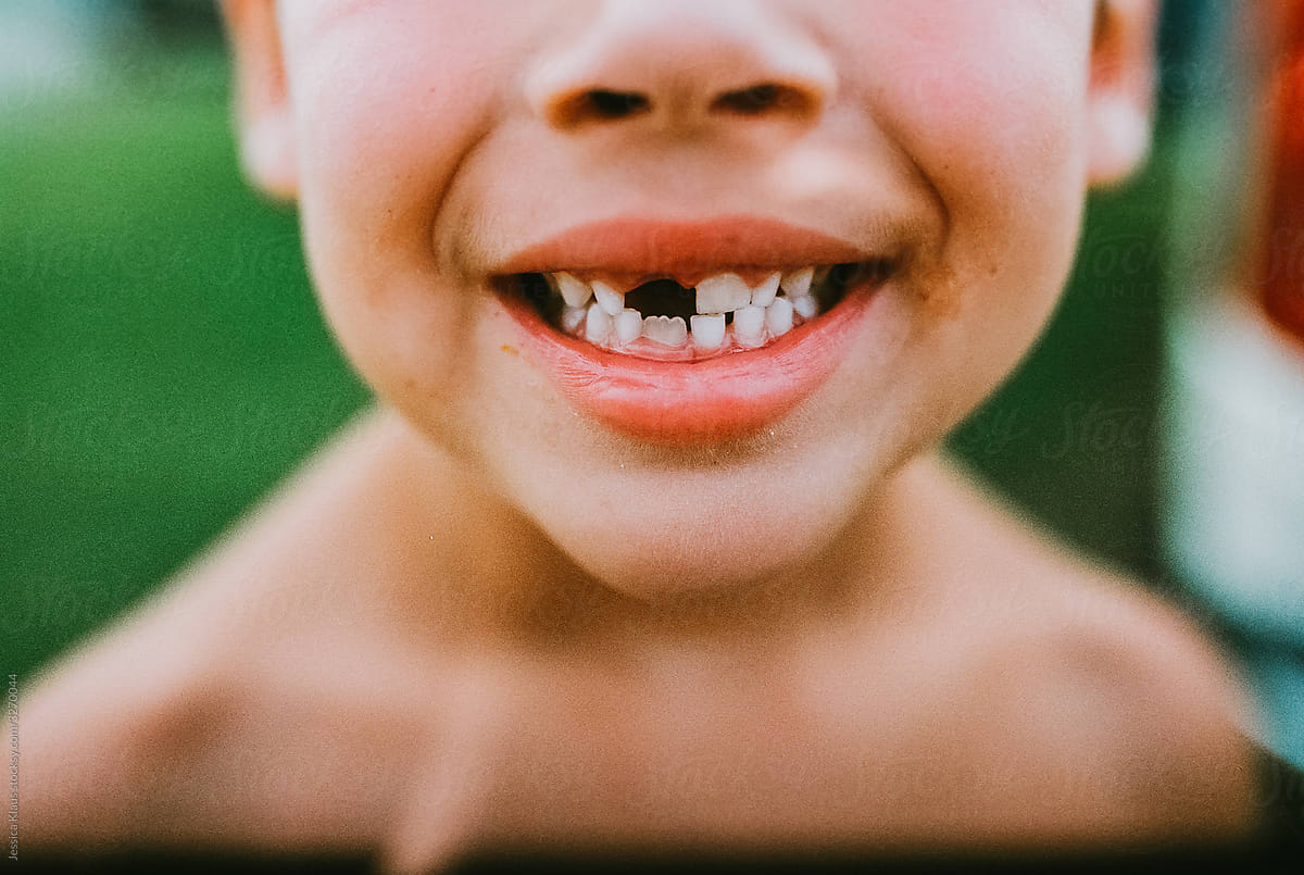 Real life childhood memories of missing teeth.