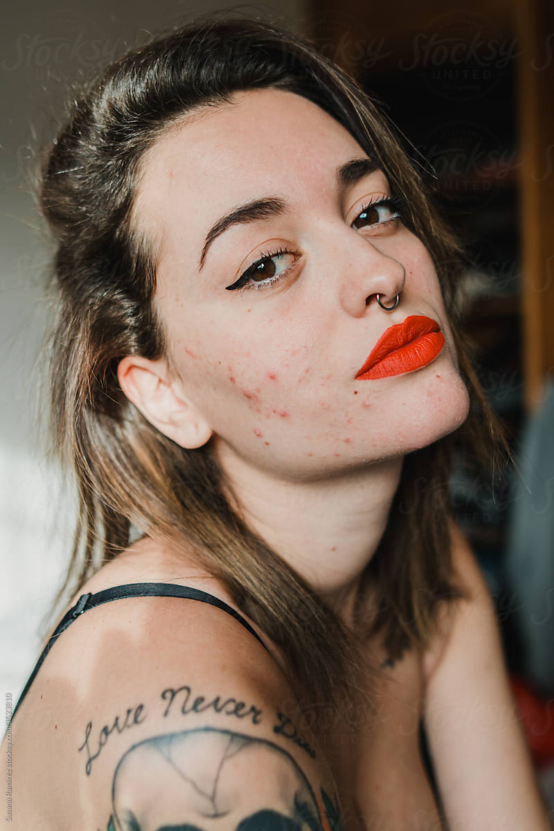Portrait of young woman with a lot of acne