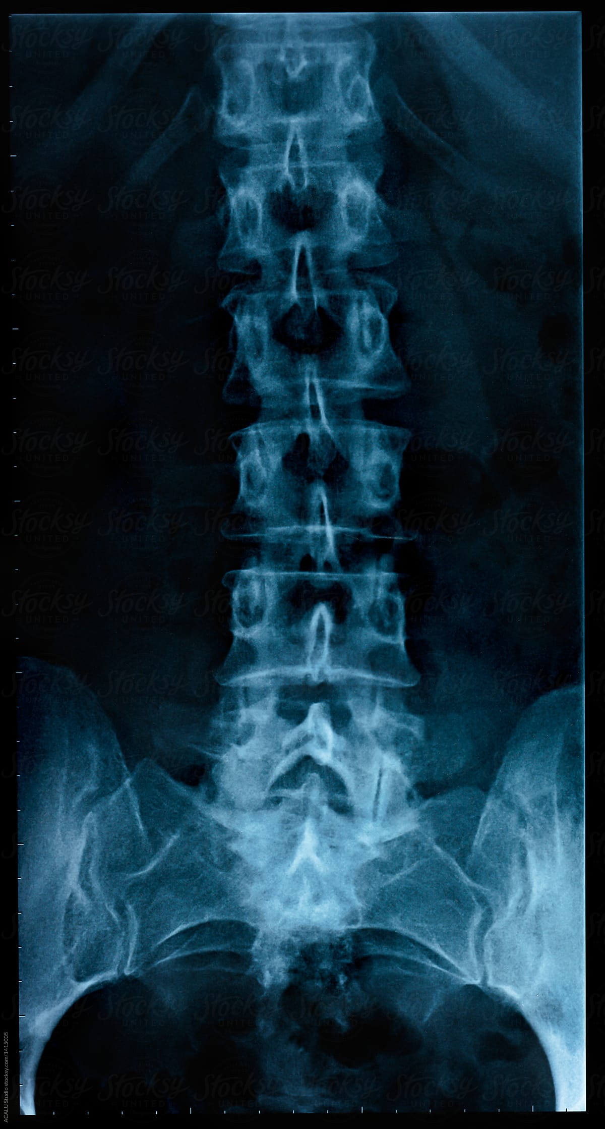 X-ray of a spine of an human