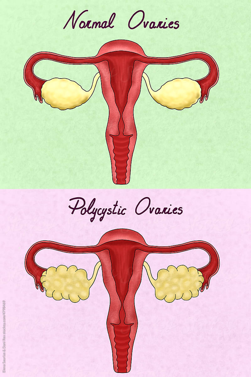 2 female reproductive system illustration, one with polycystic ovaries