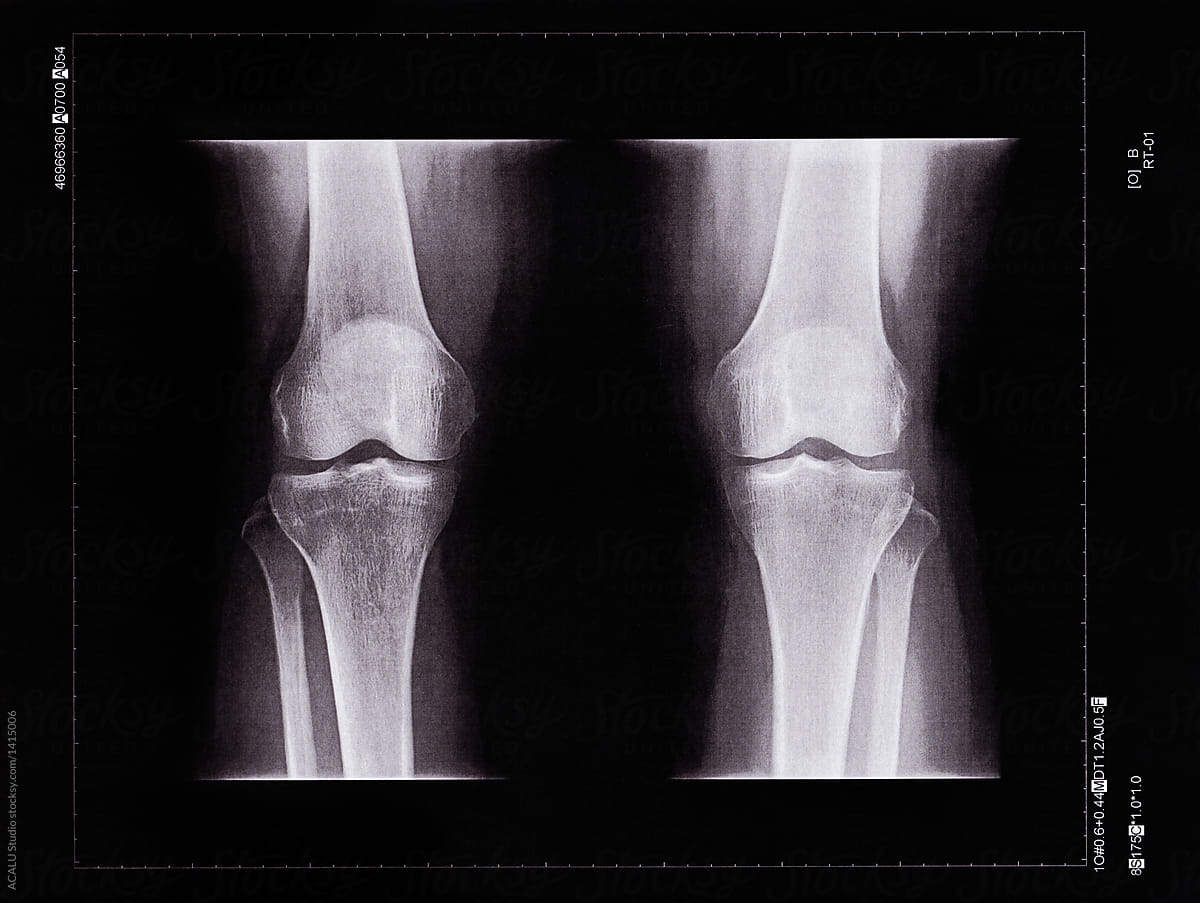 X-ray of a knee of a senior person