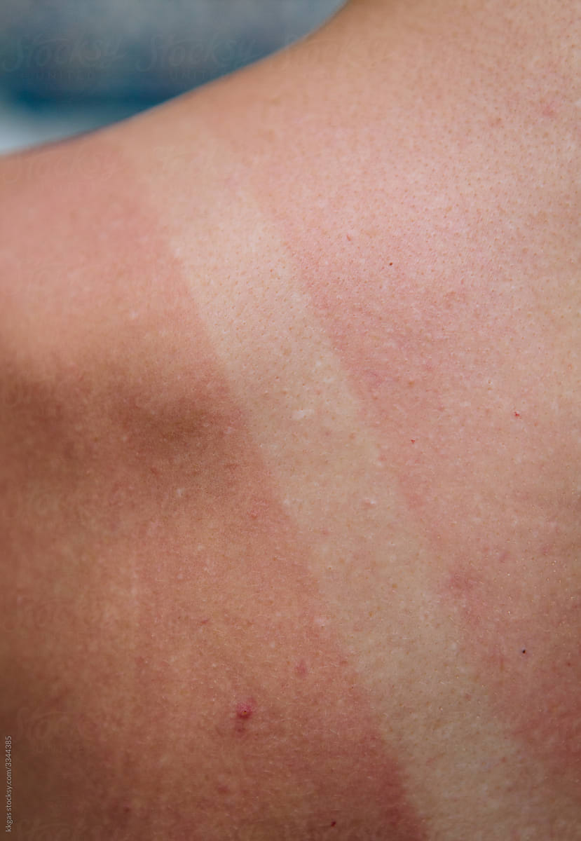 Sunburn shoulder detail.