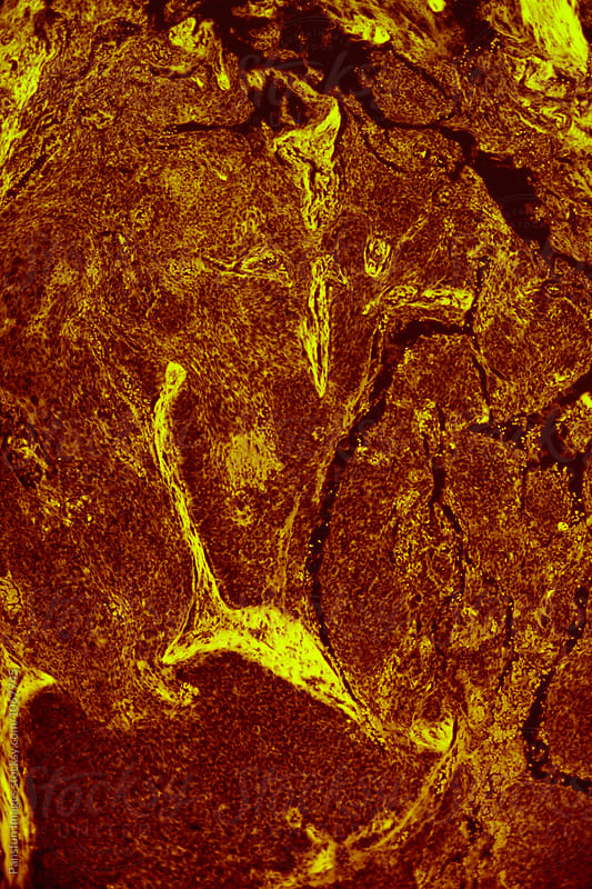 human cells of meibomian gland tumour