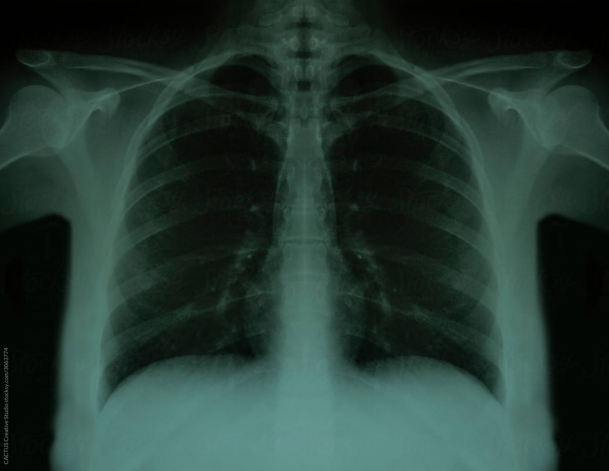 Lugs x-ray