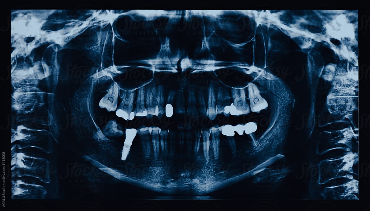 Dental X-Rays of a human jaw