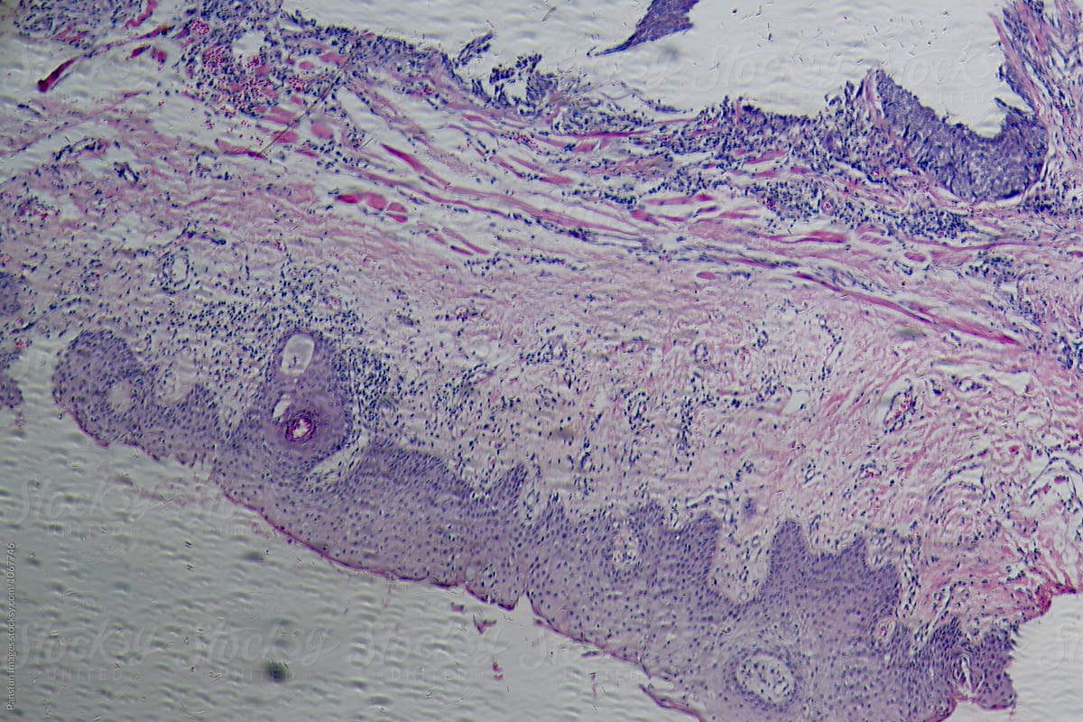 human cells of meibomian gland tumour