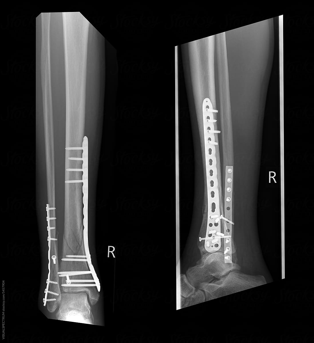 X-Ray of Broken Leg With Metal Plates and Screws