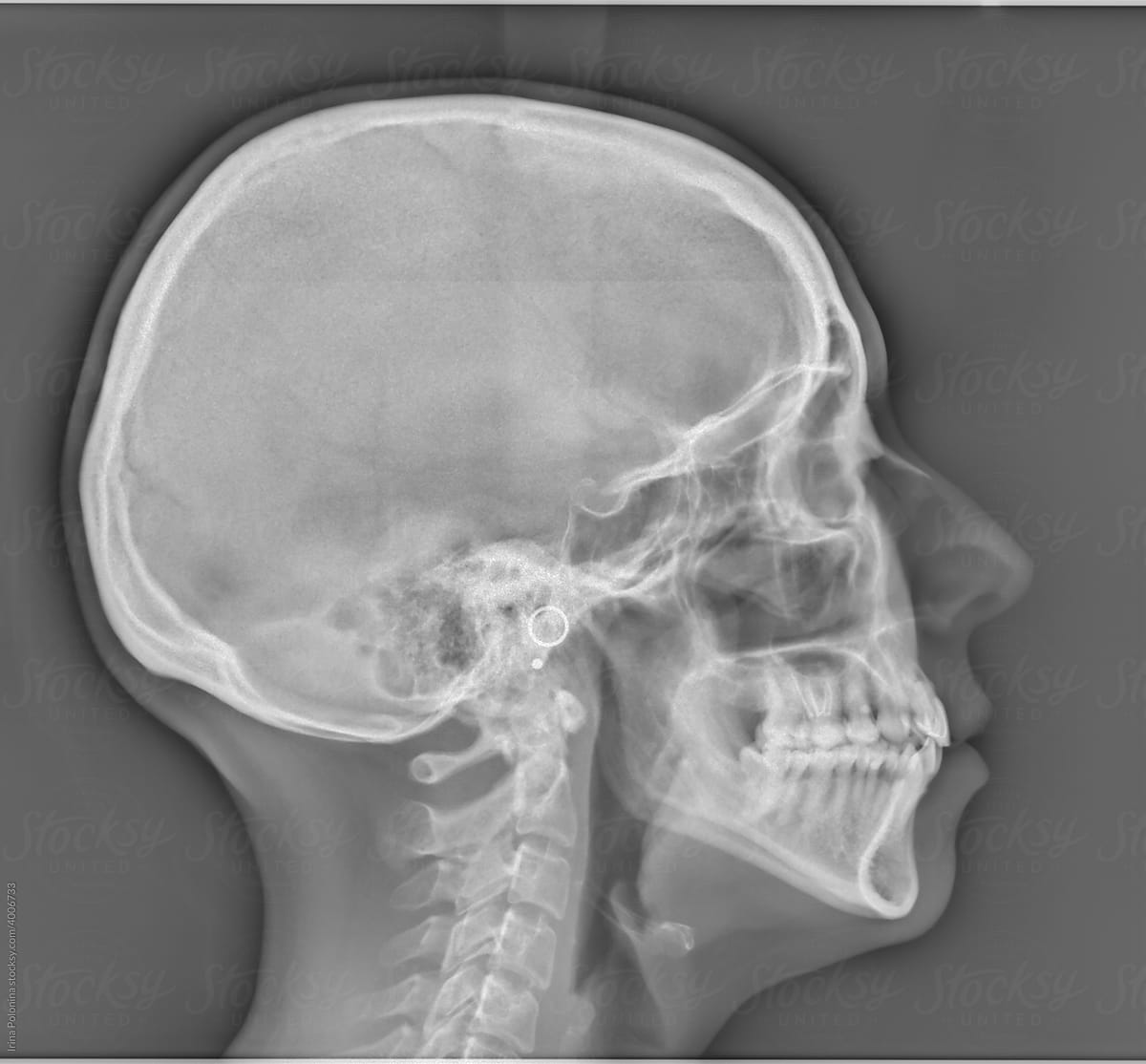 An X-ray of an adult\'s head.