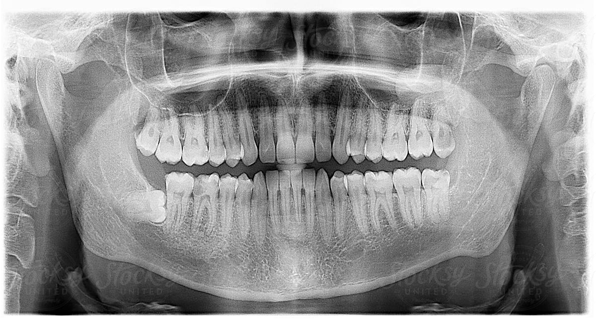 Dental X-Ray Of A Human Jaw With Bad Teeth