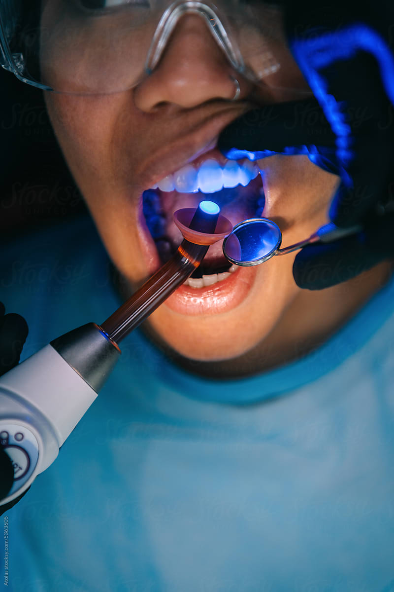 Dental light curing, blue light