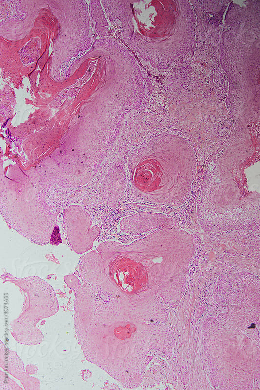 human cells, well differentiated squamous cell carcinomas