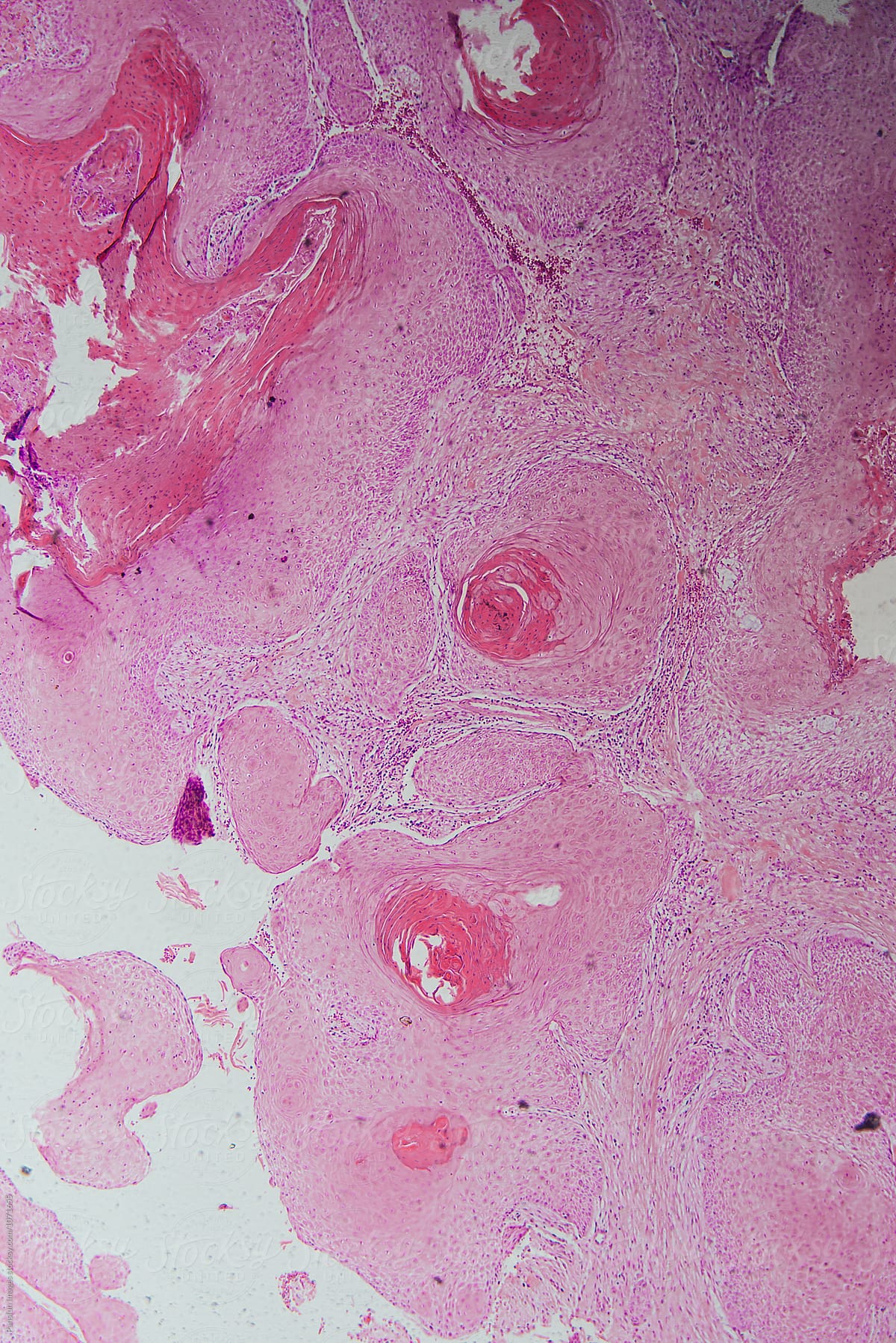 human cells, well differentiated squamous cell carcinomas