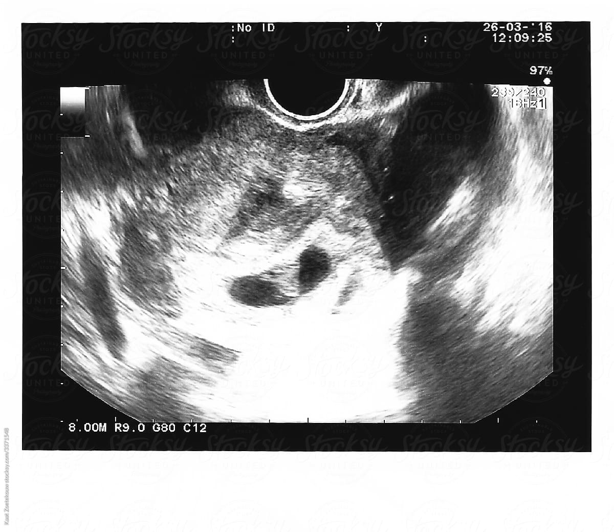 Early pregnancy viability scan