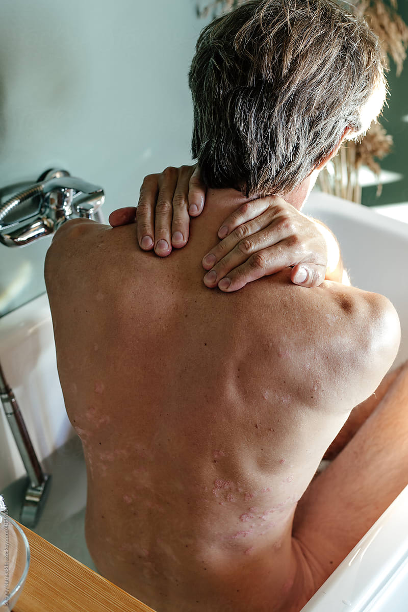 Anonymous male with psoriasis bathing in bathtub