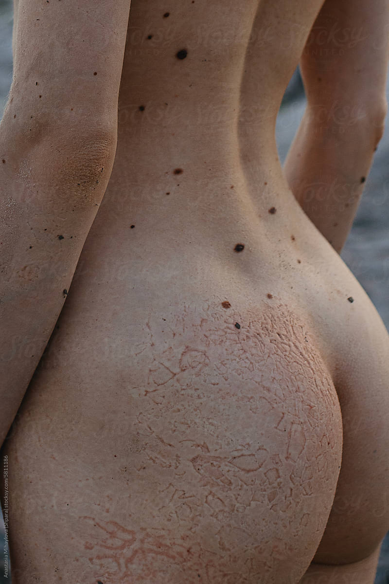 Detail-Close up photo of white skin texture with big mole on the back