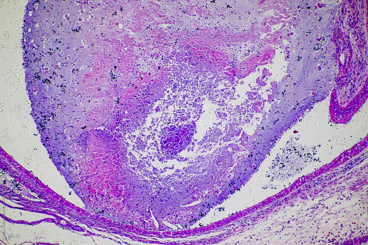 micrograph of human nasal polyp