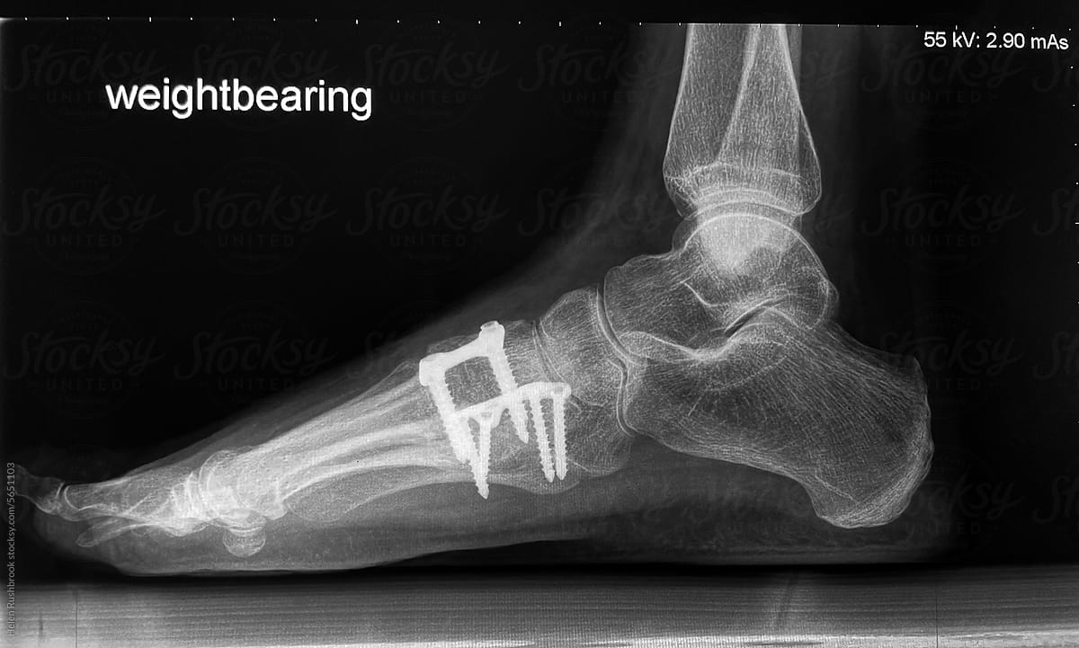 X ray of a foot that has had metal screws and plates inserted