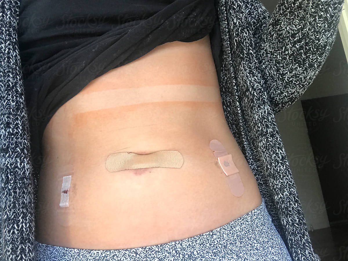 UGC bdominal surgery scar