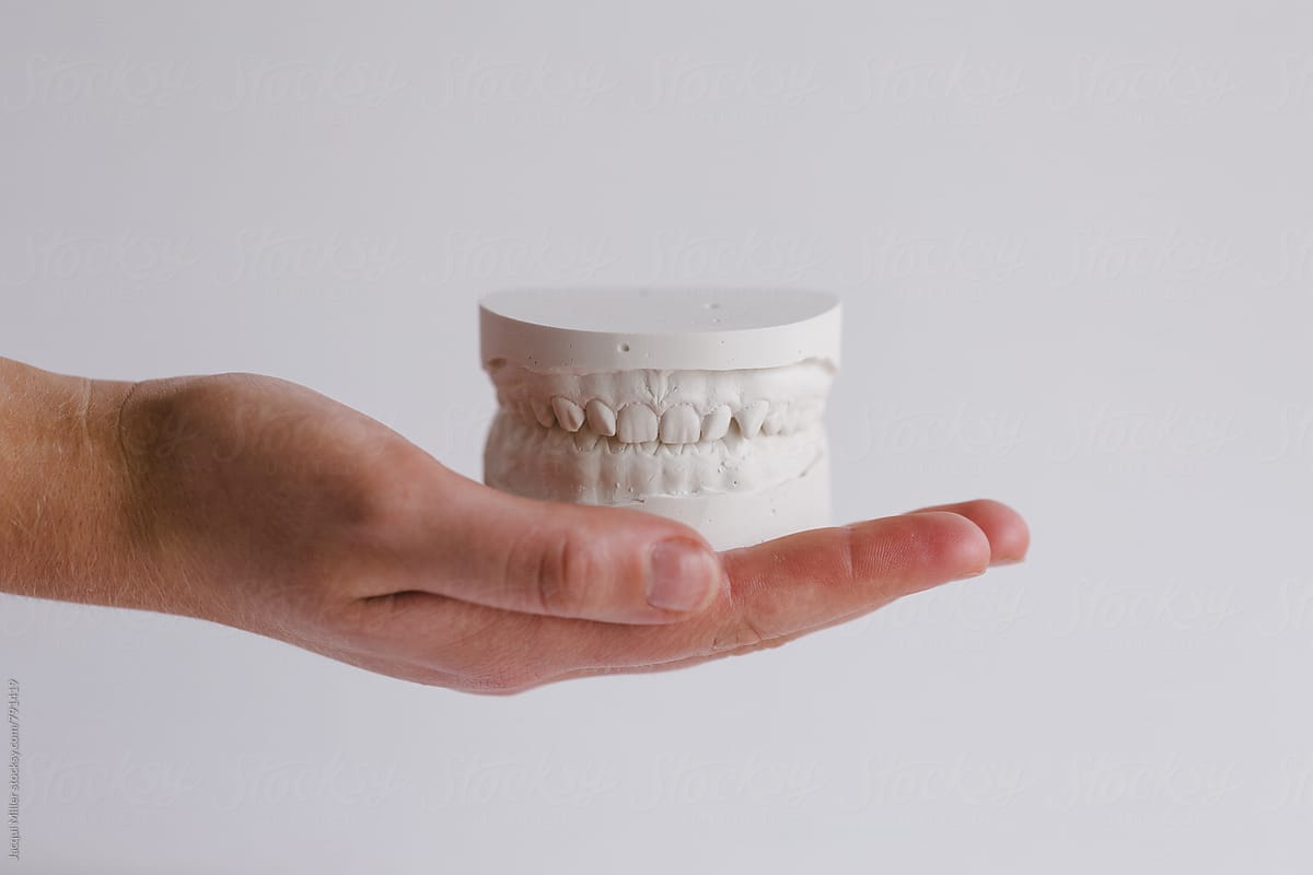 Hand holding plaster models of upper and lower teeth