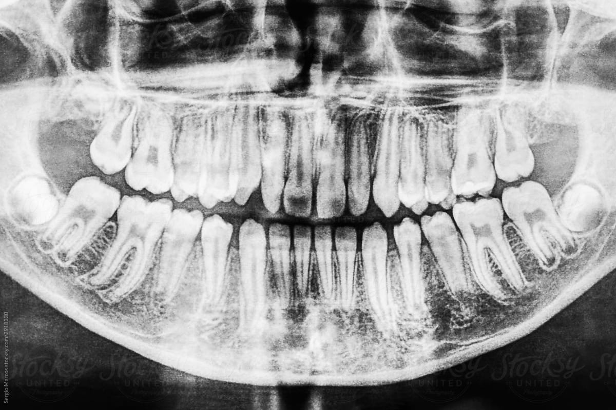 X-RAY of a patient\'s mouth