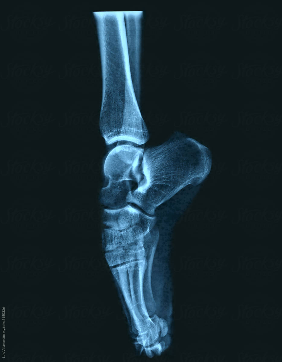 X-Ray Of A Ballet Dancer\'s Foot.