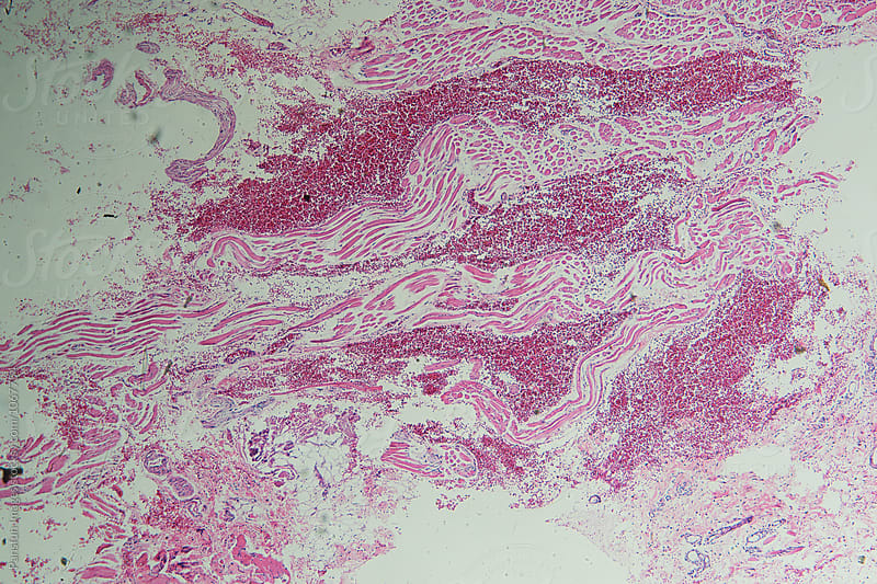 basal cell carcinoma of human