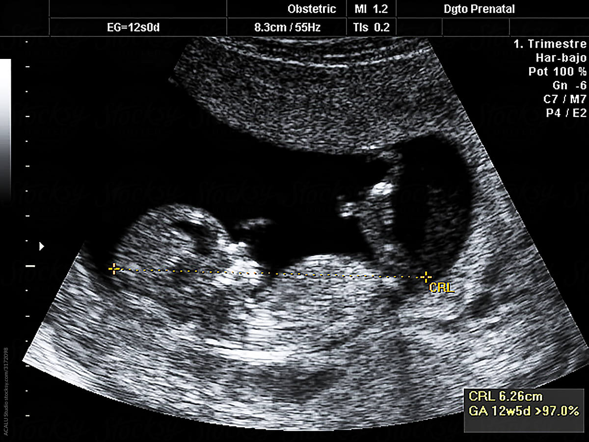 Ultrasound of a twelve week old baby in the belly