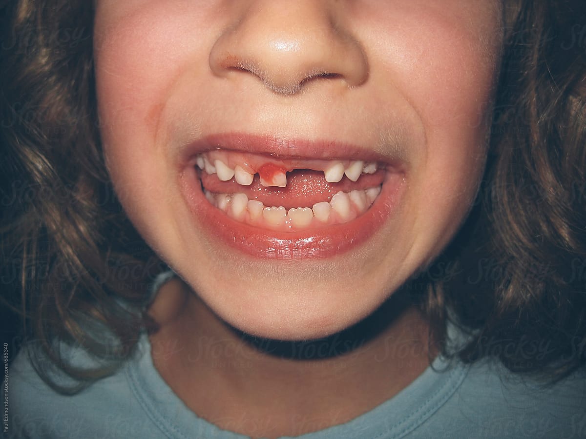 Close up of smiling young girl with missing tooth and bloody mouth