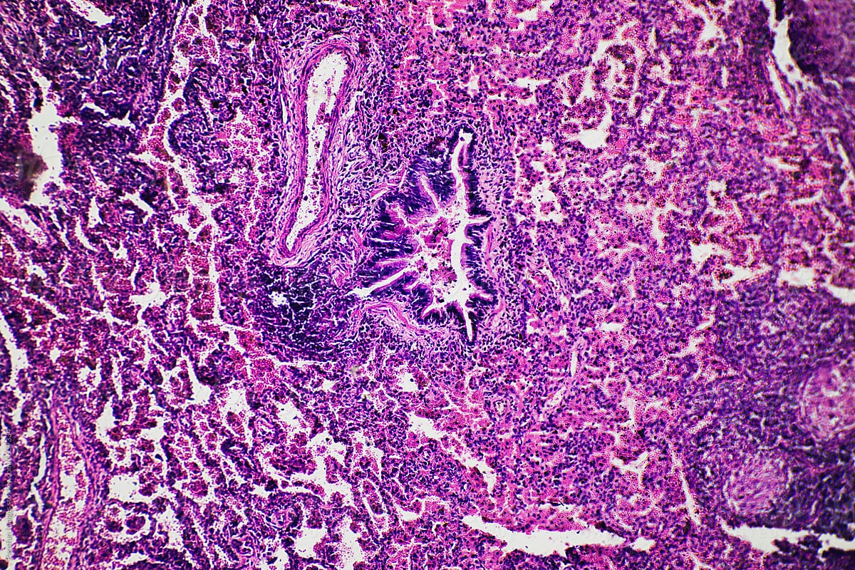 tuberculoid granuloma of hunman
