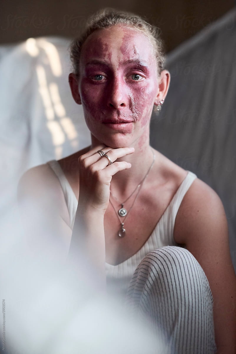 Beauty portrait of a young woman with a red birthmark on her fac