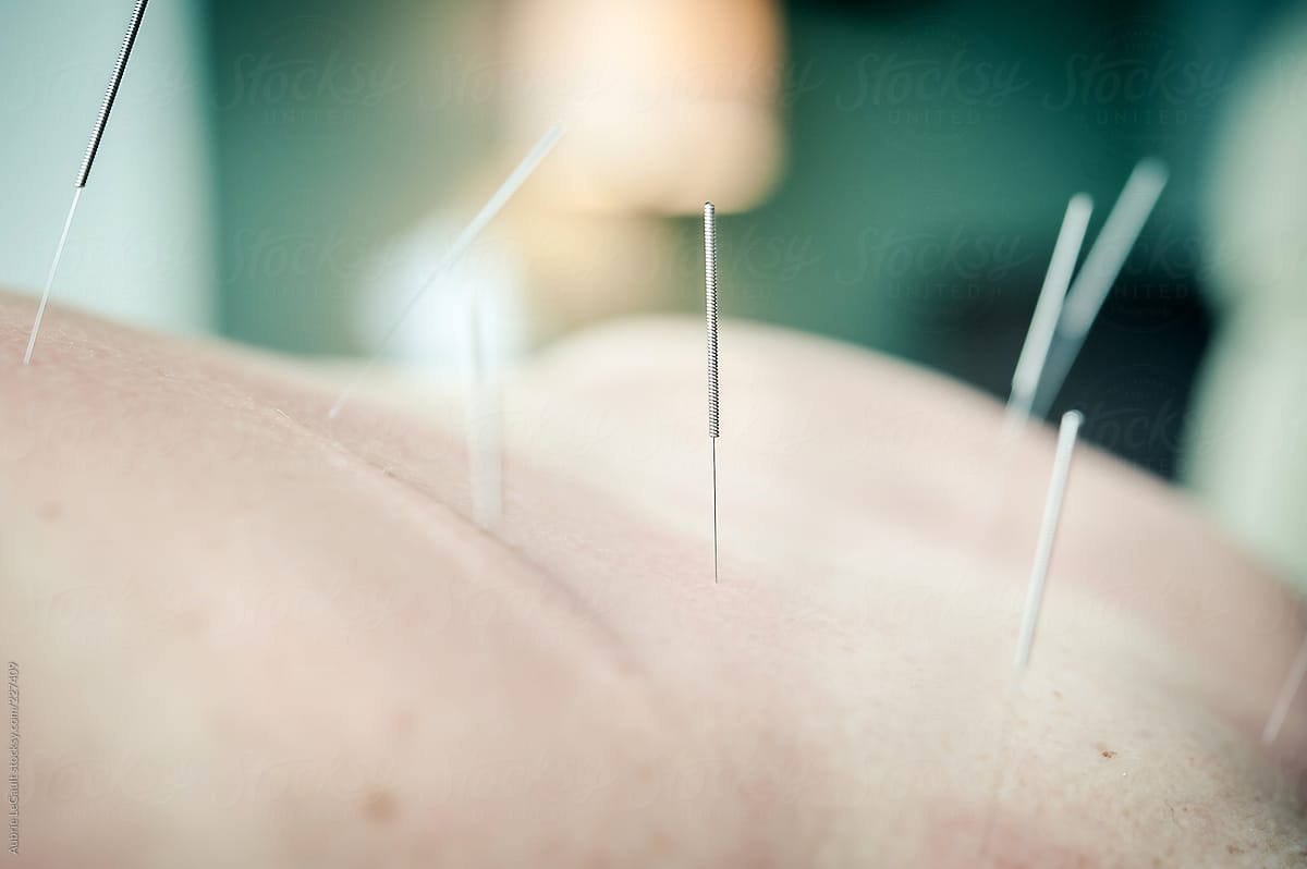Acupuncture Needles V