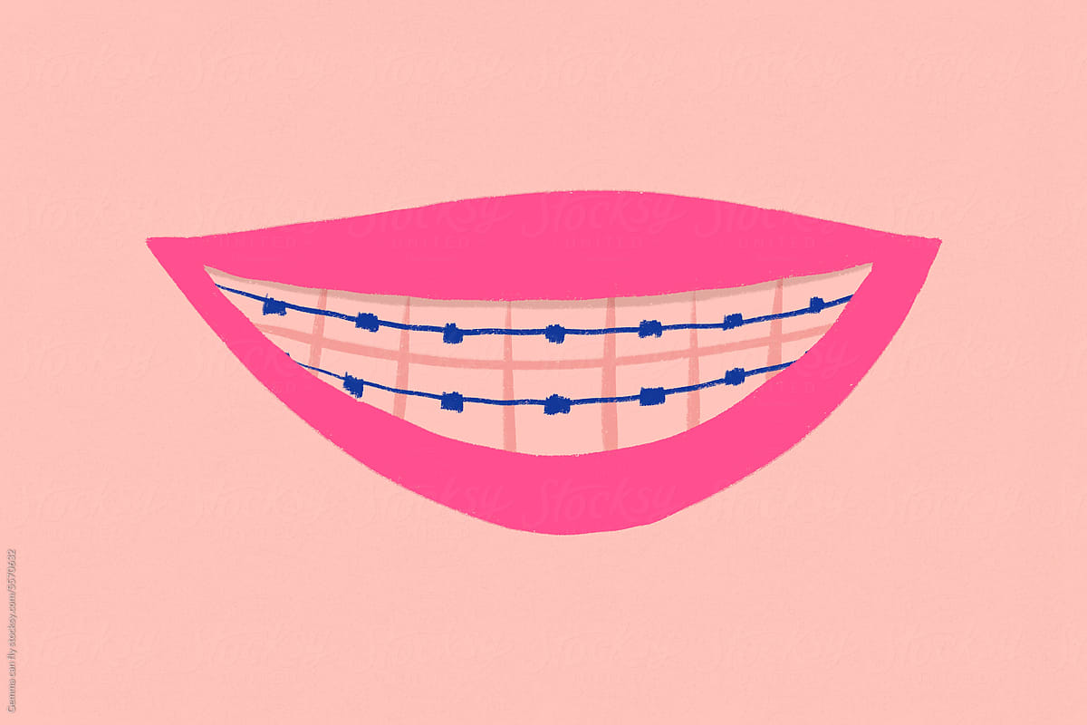 Smiling mouth with orthodontics. Dentist concept