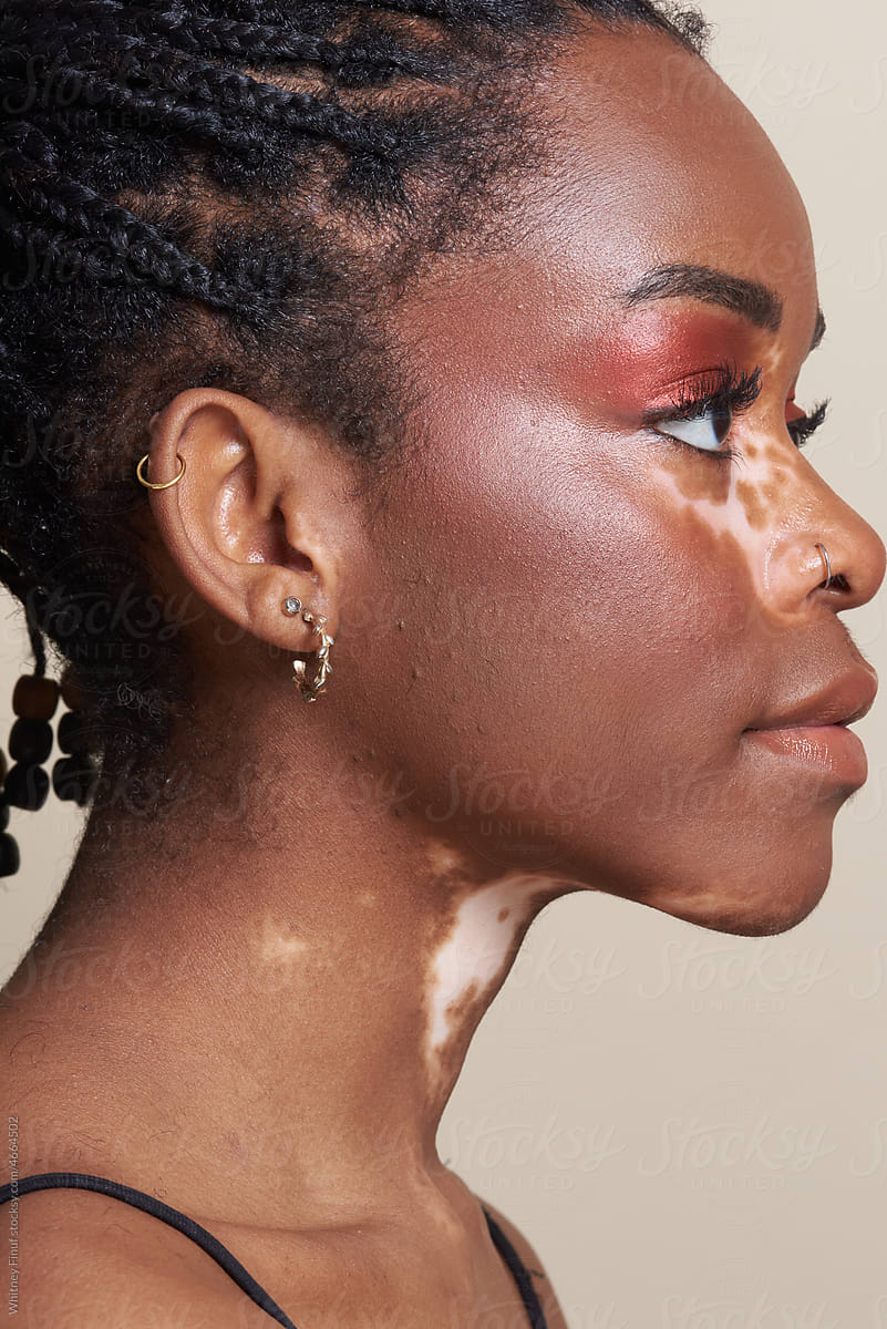 Profile of Young Black Woman\'s Face featuring Vitiligo and Hair