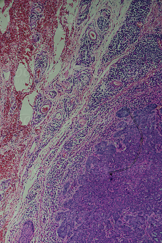 basal cell carcinoma of human