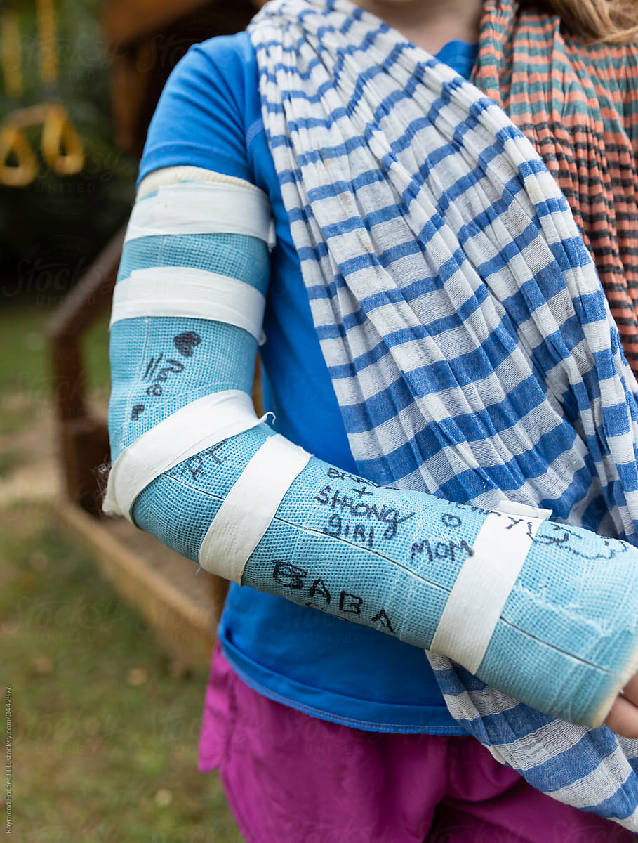 Close Up of Young Girl With Cast on Broken Arm