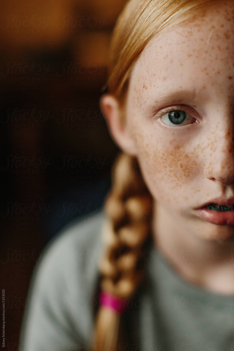Freckles Braces By Stocksy Contributor Sidney Scheinberg Stocksy