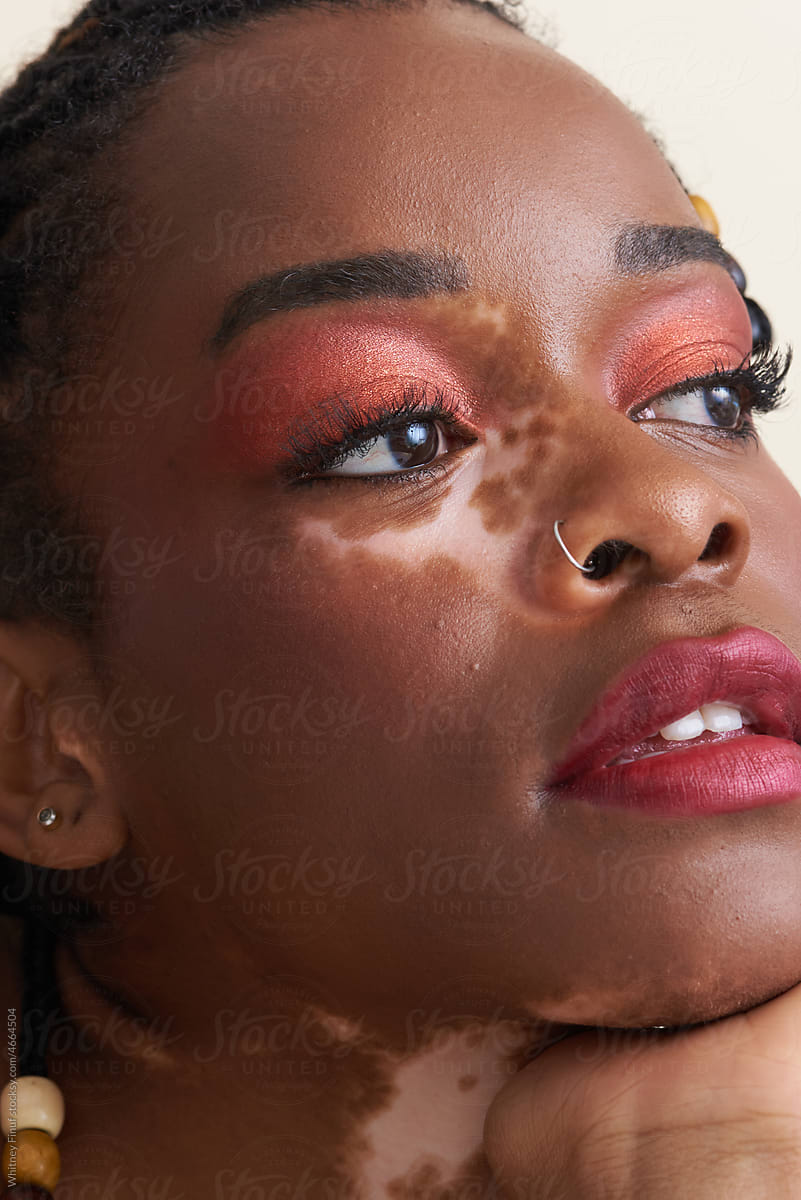 Close Up Image of Young Black Woman Gazing Off Screen with Vitiligo
