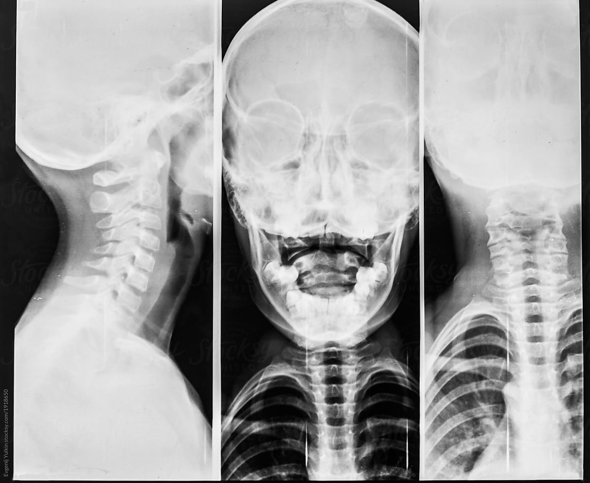 Triple radiography of children skull, neck and ribs