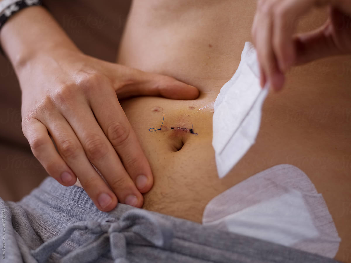 Man removing bandage from surgical stitch